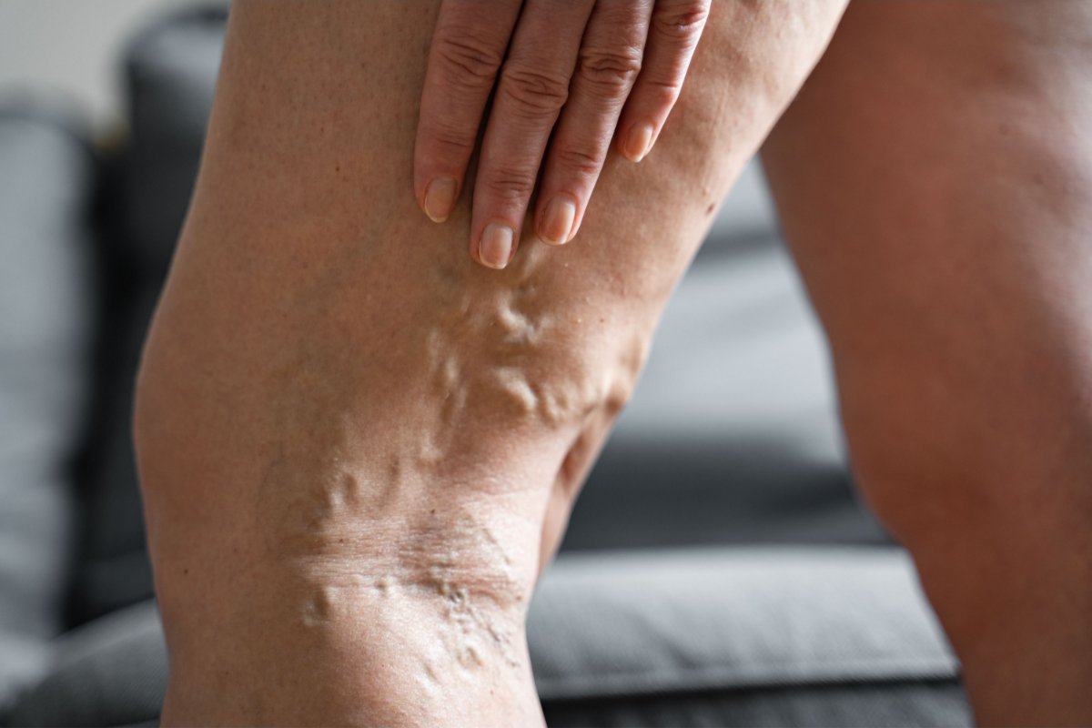 Varicose vein and venous reflux evaluation at South Texas Vascular Institute in Edinburg, TX